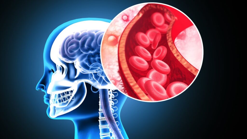 Stanford researchers develop stroke treatment that changes the game that doubles effectiveness